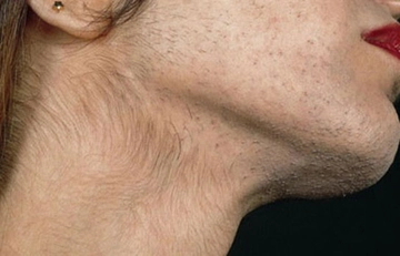 Hormon Dengesizliği Nedenleri?